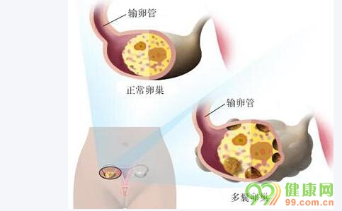 什么是多囊卵巢綜合癥 多囊卵巢綜合癥的原因 多囊卵巢綜合癥怎么治療